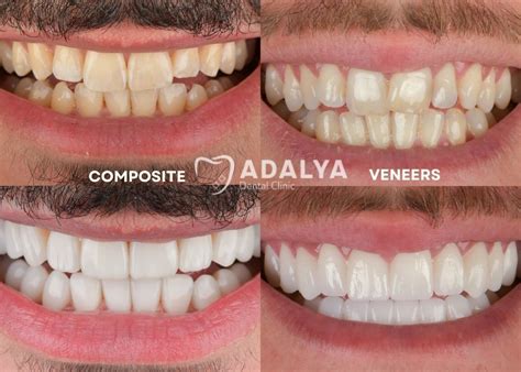 composite bonding  veneers key differences  teeth