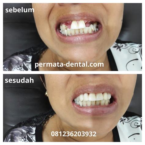 arti mimpi gigi lepas 2 bagian bawah 2