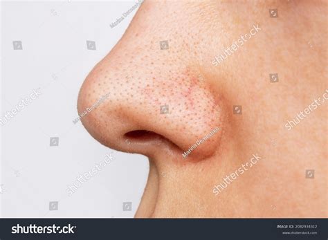 nose blackheads images stock  vectors shutterstock