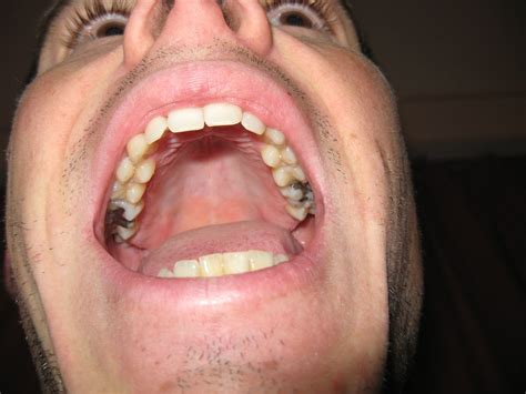 upper jaw  silver fillings  silver amalgam fillings flickr