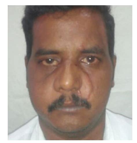 complex traumatic facial degloving injury journal  case reports