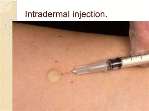 Intradermal injection- Introduction, procedure,complications | PPT