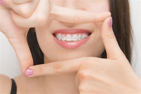 braces langleys dental care