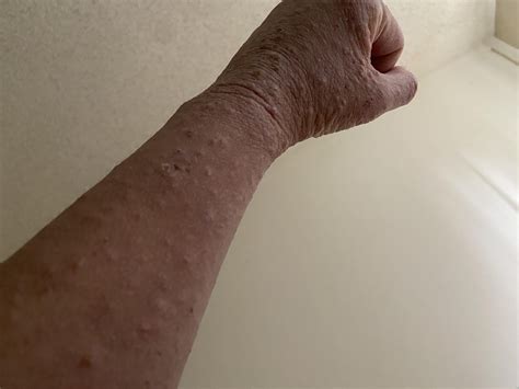 hi can anyone help me identify these bumps? : r/skin