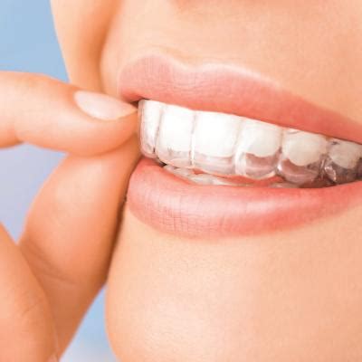 aligners fit  practical guide  patients