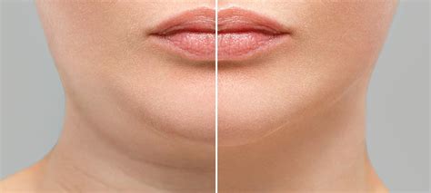 Botox for Sagging Jowls Before and After - SA