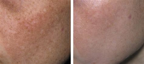 Pigmentation | Before & After | Kingsway Dermatology