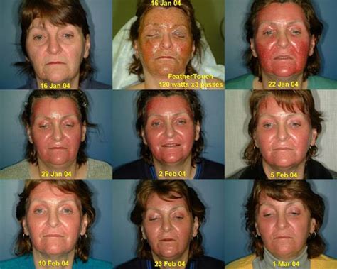 What is blue light skin treatment? - paperwingrvice.web.fc2.com