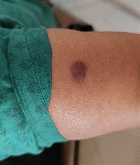 Dark spot poped out in upper right arm, Not itchy, no pain uppon