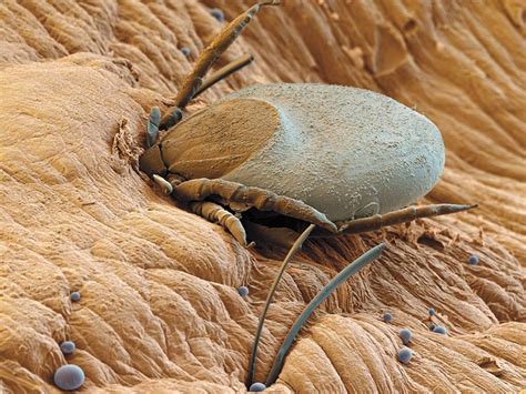 Carrapato Dentro Da Pele Humana - Microscopio De Pele Humana