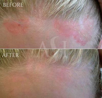 Psoriasis Results - American Skin Institute