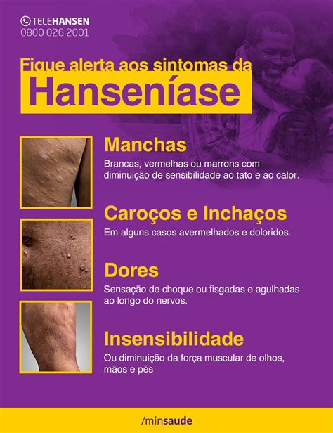 Quais Os Sintomas Da Hanseníase