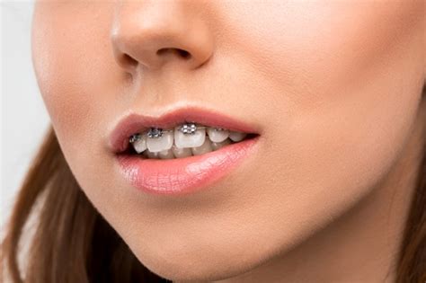 How to Fix Overbite With Overbite Braces & Other Treatments? - Smile ...