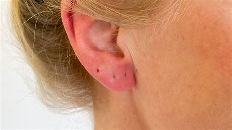 how to fix ear piercing infection