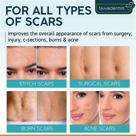 Buy Scar Cream Gel - Retinol, Allantoin, Vitamin E, Betaine - C-Section