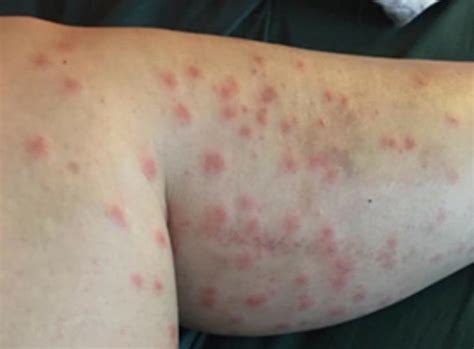 Don't let swimmer's itch happen to you - East Idaho News