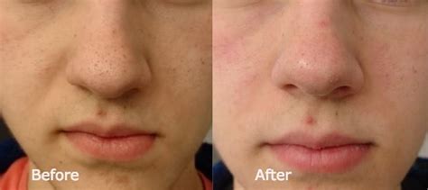 Unbelievable Blackhead Removal 2024: Before and After Pictures (Real People!) - y7zukda