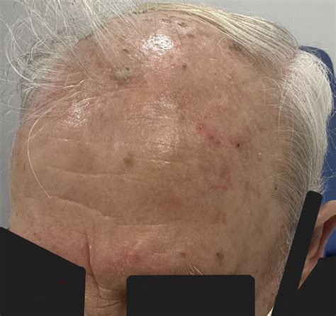 Actinic Keratosis Treatment | Legacy Dermatology