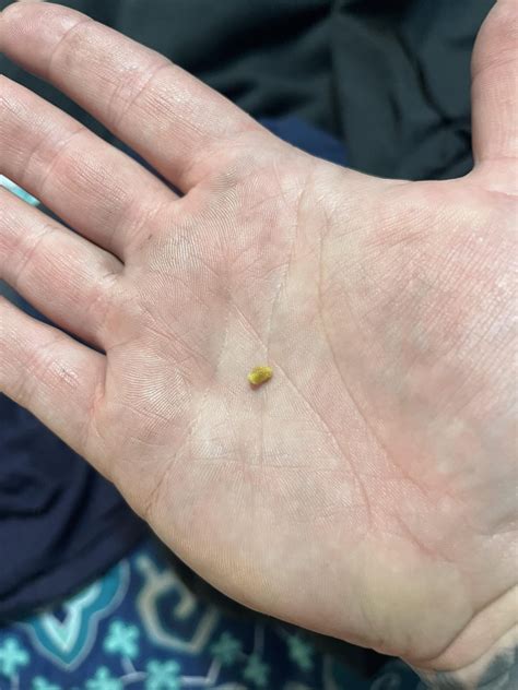 passed  kidney stone today rpics