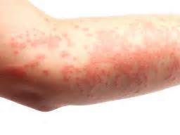 Hives Rash / 10 Serious Conditions That Rashes And Hives Can Indicate | Things Health ...