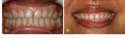 figure    aesthetic management   midline diastema