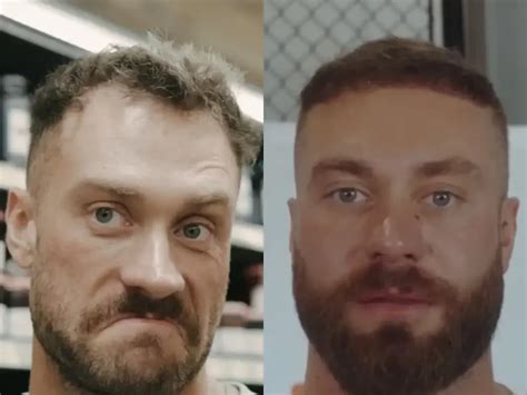 Elon Musk Hair Transplant l Before and After