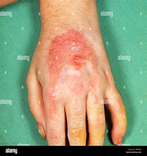 burn stock photo alamy