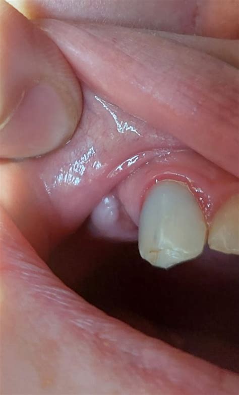 bot vergroeiing na trekken kies tandartsnl forum