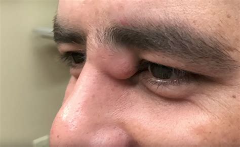 Dr. Pimple Popper Removes Massive Cyst From a Man's Eye Area | Allure