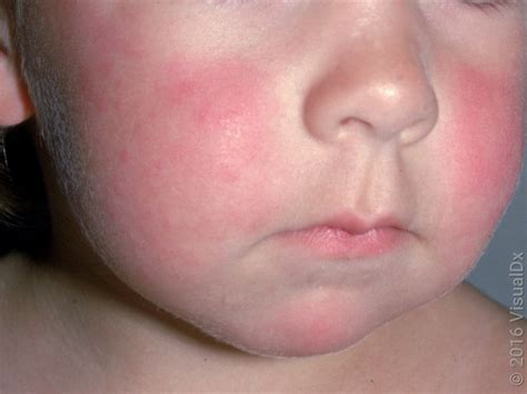 11 Common Rashes on Kids and Preschoolers (With Images) - GoodRx