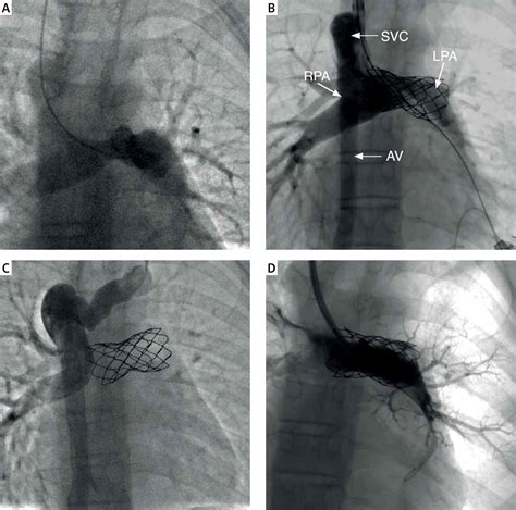 The usefulness of the Rotarex thrombectomy system in the recanalization