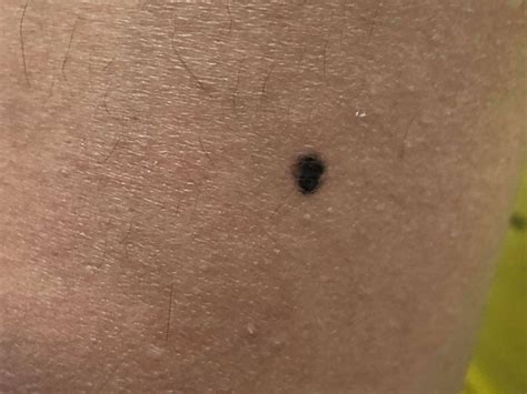 understanding nodular melanoma   symptoms vrogueco