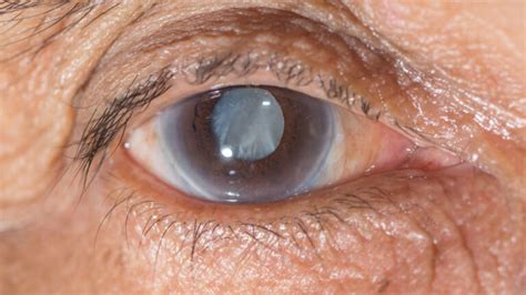 department  cataract dr shroffs charity eye hospital