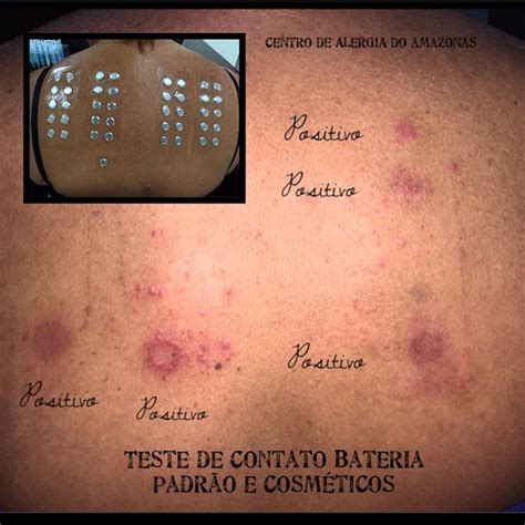Teste De Contato 30 Substancias Quais Sao - CAIAM - Centro de Alergia e Imunologia do Amazonas - Teste de Contato ...