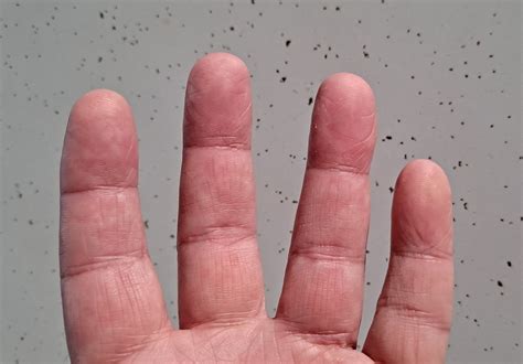 how to get rid of calluses on your feet 6