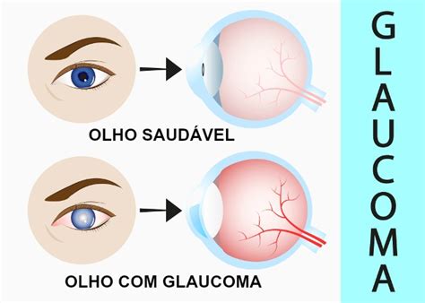 O Que Causa O Glaucoma - Glaucoma - Biologia Net