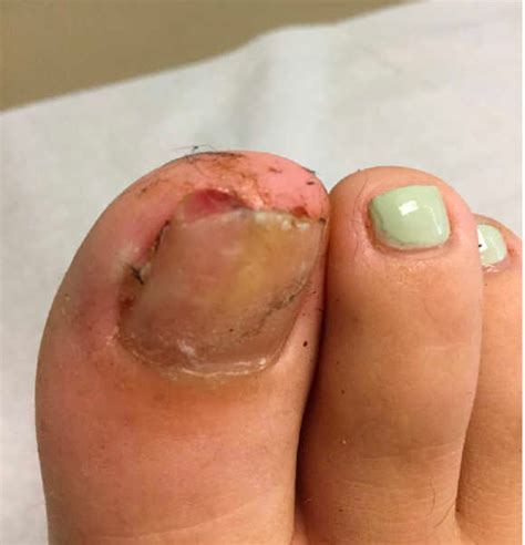 What’s under my toenail? | MDedge Pediatrics