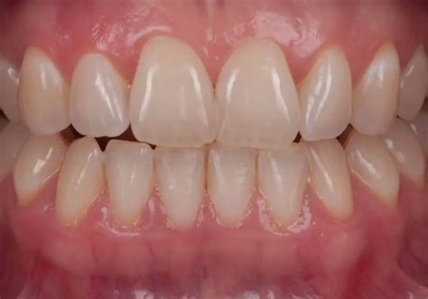 teeth     understanding tooth transparency