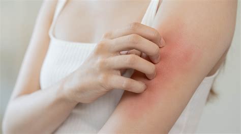 Skin Rash: Understanding the Various Triggers - HealthKart