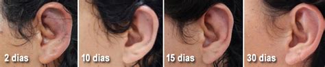 Orelhas Inchadas E Vermelhas - Por que as orelhas ficam muito inchadas depois da otoplastia? | Blog da ...