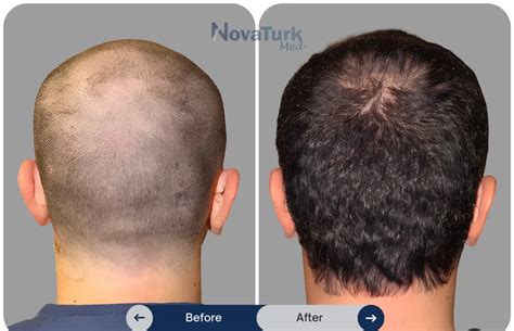 A Comprehensive Guide to Hair Transplant Aftercare
