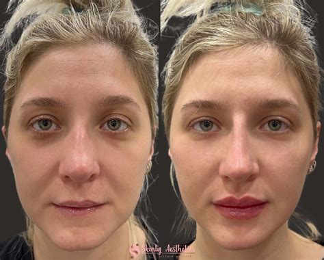 Juvederm Cheekbones