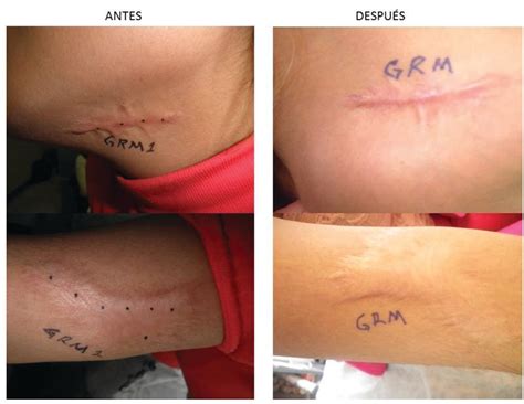 Cicatricure Queloide Antes E Depois - Uso de toxina botulínica en cicatriz queloide | Cirujano General