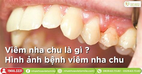 Viêm nha chu là gì? Hình ảnh bệnh viêm nha chu