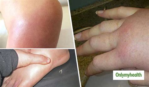 disease  swelling   body infoupdateorg