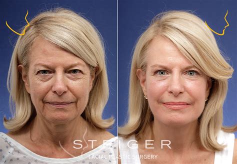 Face Lift Deep Plane at Sergio Hasting blog