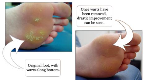 Plantar Wart Causes And Treatment | Gallery Demax