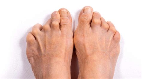 kenali penyebab gejala  terapi  rheumatoid arthritis fisiohome