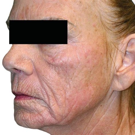 wrinkle reduction skin resurfacing beauty kingdom