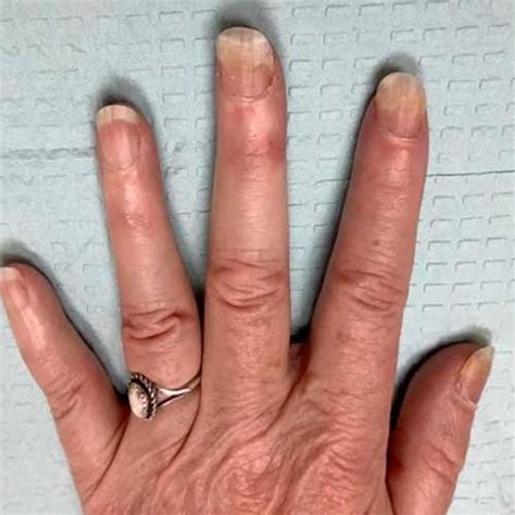 onycholysis dr dana stern dermatologist nail specialist